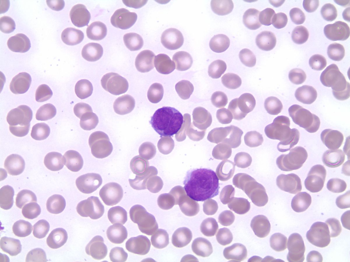 Blast with bilobed nuclei